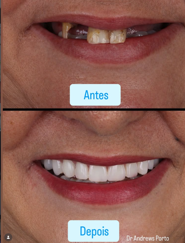 Caso 2 — antes e depois