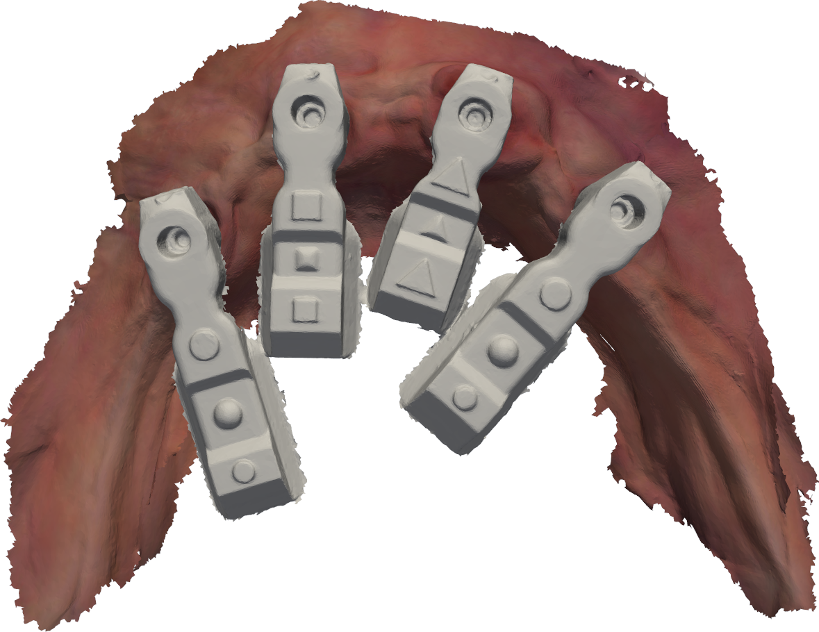 Axisbody scanbodies posicionados no rebordo